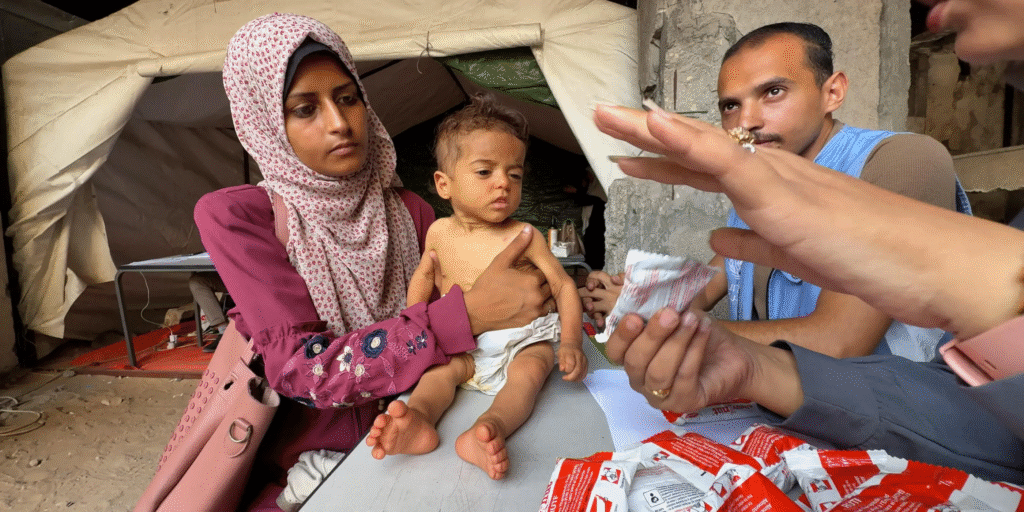 A imagem de Iman, uma menina de apenas seis meses, reflete o drama enfrentado por milhões em Gaza. Examinada em 12 de julho de 2025 - Fonte: UNRWA, OCHA